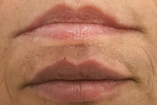 Aumento de Labios con ácido hialurónico en Sevilla Este - Estella Beauty Center